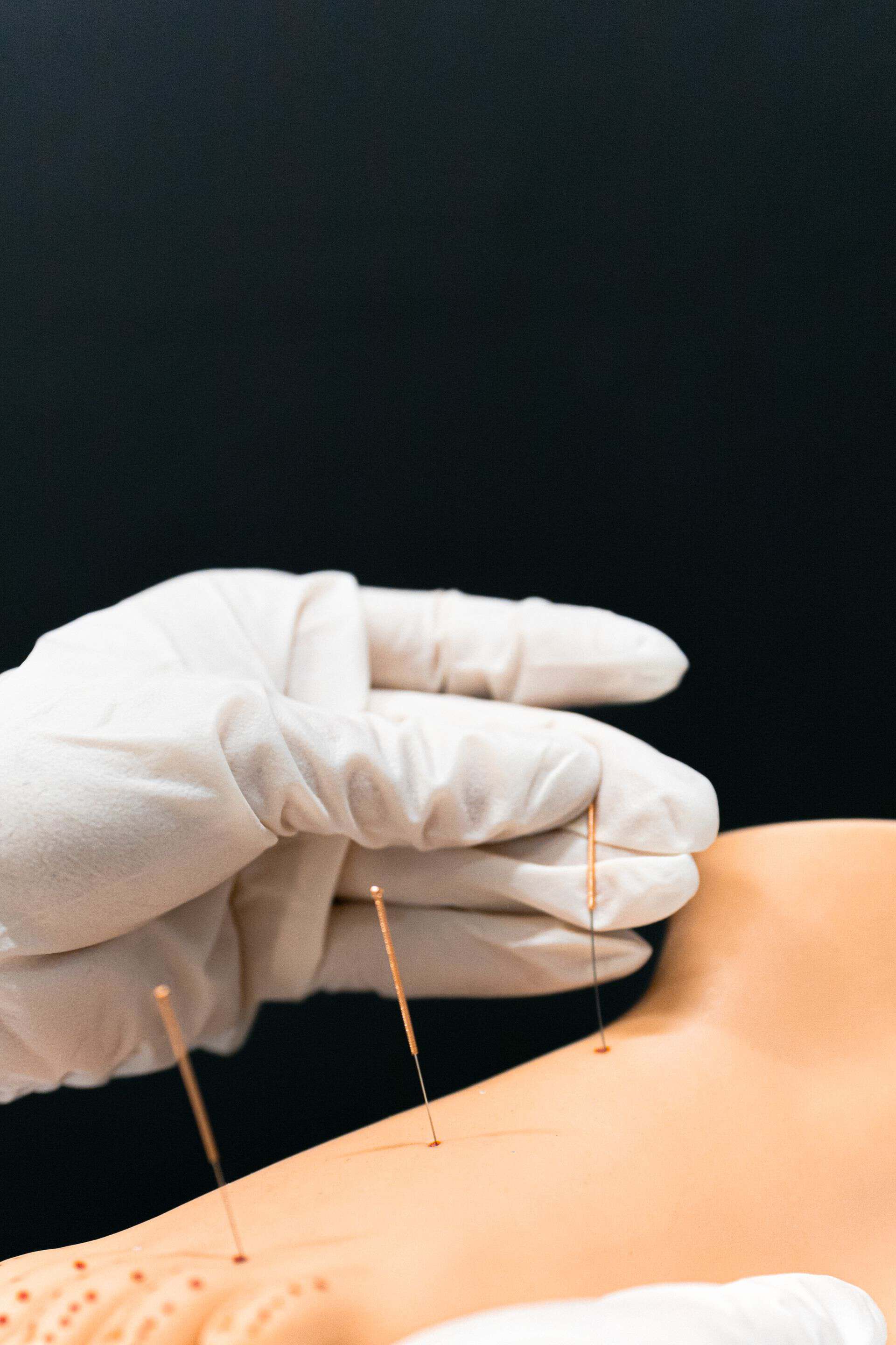 izjotpeuta w rękawiczce wykonujący zabieg suchego igłowania w klinice Villa Medica we Wrocławiu w celu redukcji bólu.
